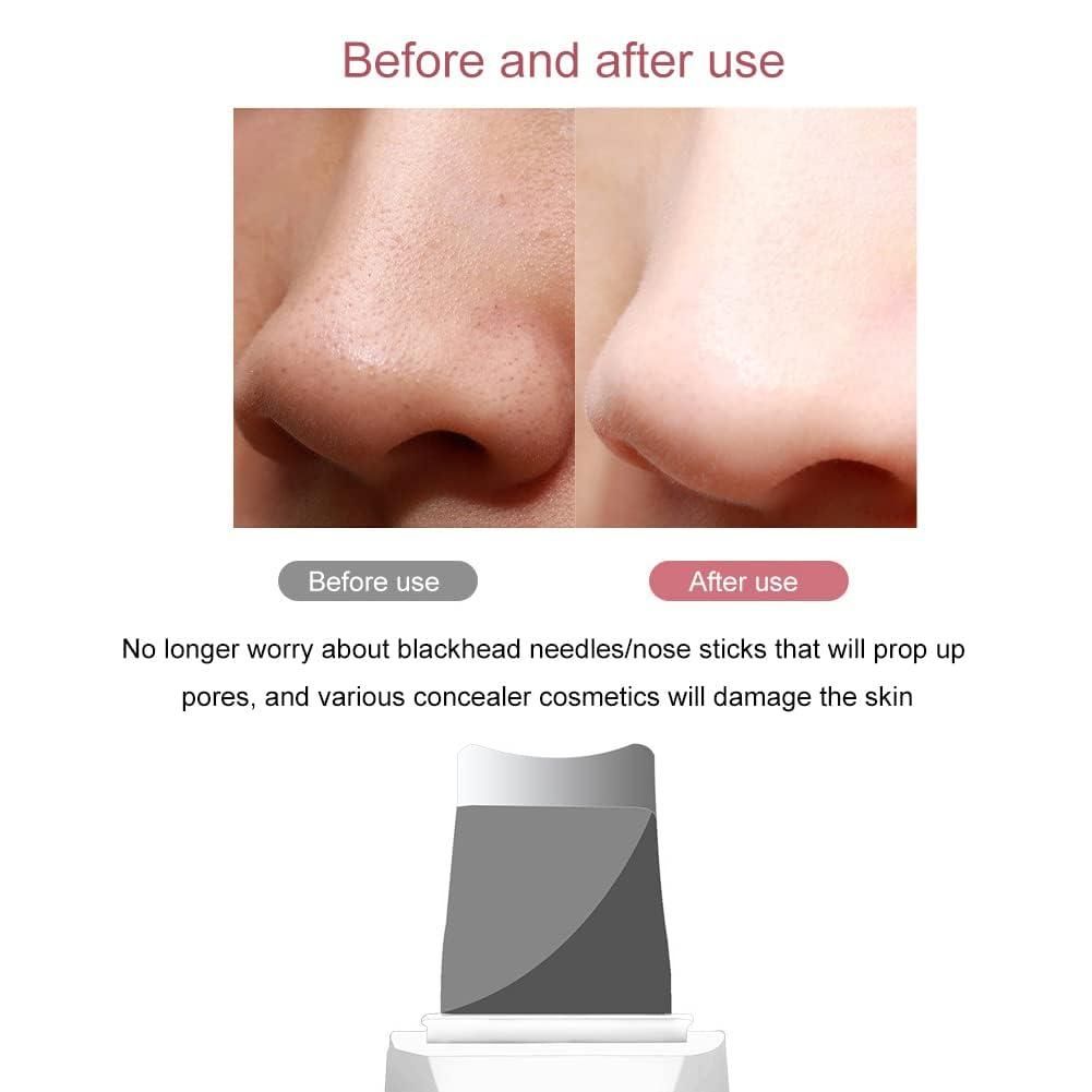 Ultrasonic Facial Kit White Heads And Blackhead Remover Removal Tool
